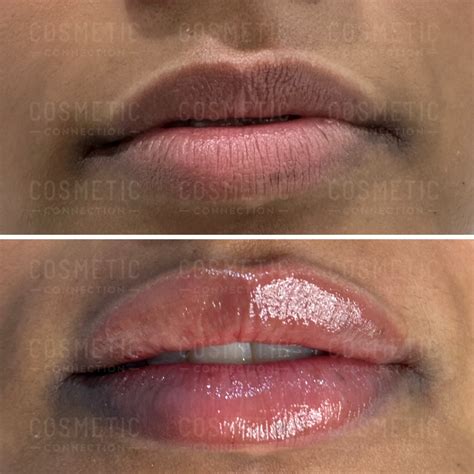 Understanding 1ml Lip Filler Impact